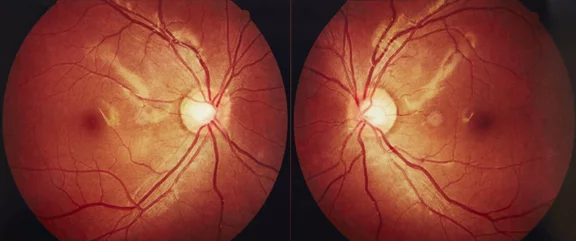 Gros plan sur la macula