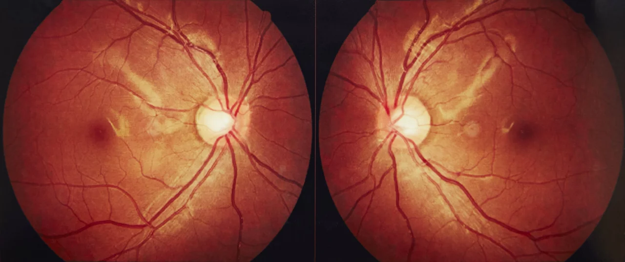 Gros plan sur la macula