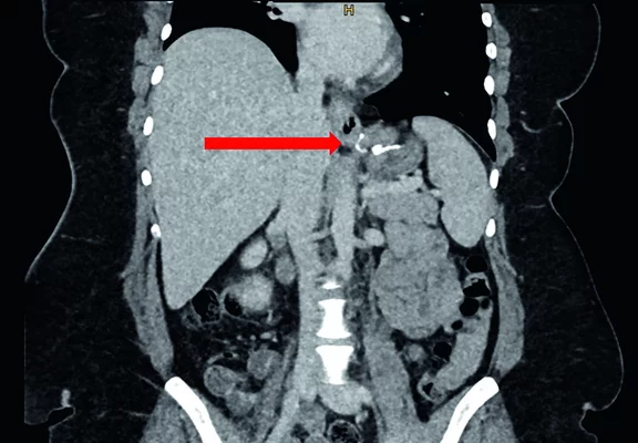 Traitement du reflux gastro-œsophagien et des hernies hiatales