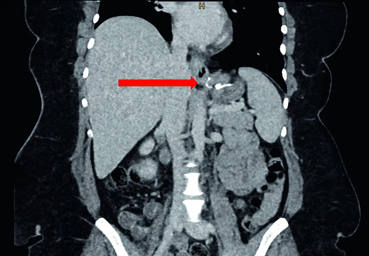 Traitement du reflux gastro-œsophagien et des hernies hiatales