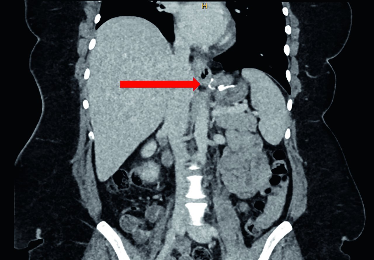 Behandlung der gastroösophagealen Refluxkrankheit und Hiatushernien 