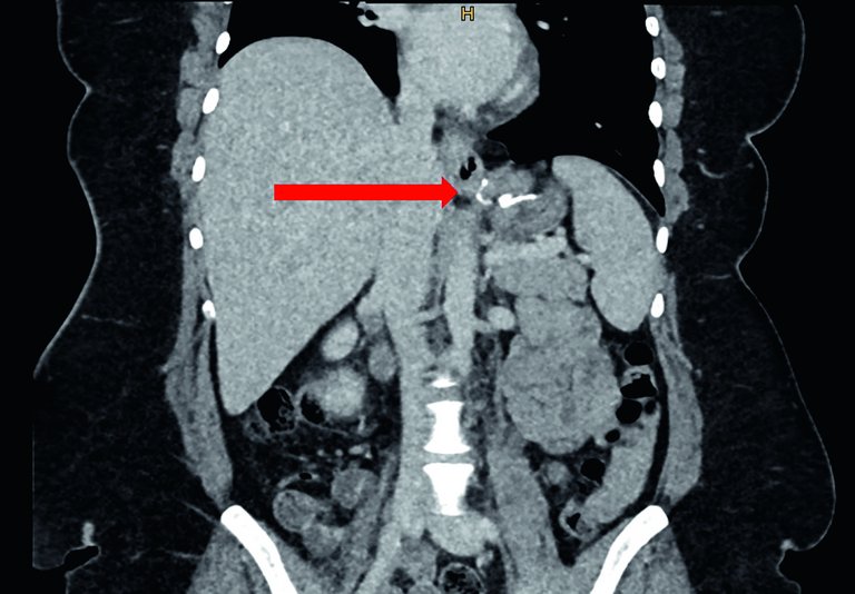 Behandlung der gastroösophagealen Refluxkrankheit und Hiatushernien 