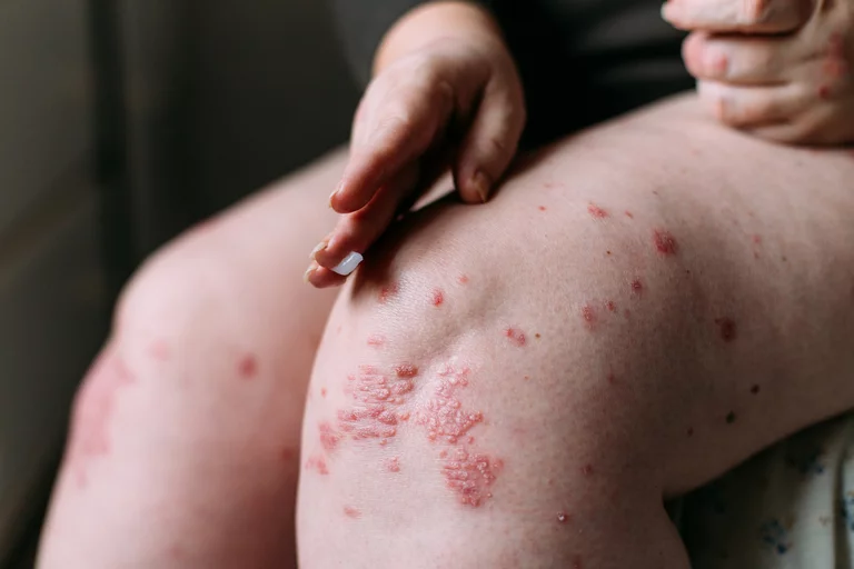 applying an emollient to dry flaky skin as in the treatment of psoriasis, eczema and other dry skin conditions. Skin problem concept