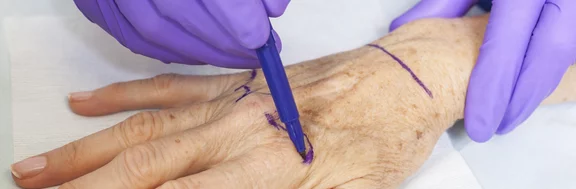 Chirurgie de la main: quels bénéfices pour le patient ?