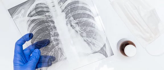 «La prévention de la pneumonie est un travail d’équipe»
